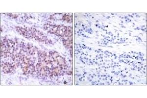 Immunohistochemistry analysis of paraffin-embedded human breast carcinoma, using BCL-XL (Phospho-Ser62) Antibody. (BCL2L1 anticorps  (pSer62))