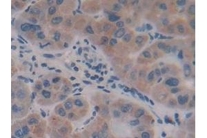 Detection of AFP in Human Liver cancer Tissue using Polyclonal Antibody to Alpha-Fetoprotein (AFP)