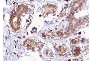 ABIN6267278 at 1/100 staining human Breast carcinoma tissue sections by IHC-P.