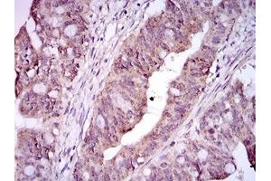 Immunohistochemical analysis of paraffin-embedded rectum cancer tissues using ITGA2B mouse mAb with DAB staining. (Integrin Alpha2b anticorps  (AA 45-149))