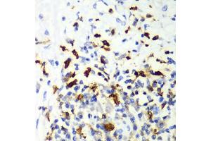 Immunohistochemistry of paraffin-embedded human liver cancer using CAPG Antibody (ABIN6132242, ABIN6137908, ABIN6137909 and ABIN7101810) at dilution of 1:100 (40x lens). (CAPG anticorps  (AA 1-348))