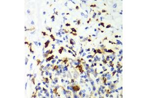 Immunohistochemistry of paraffin-embedded human liver cancer using CAPG Antibody (ABIN6132242, ABIN6137908, ABIN6137909 and ABIN7101810) at dilution of 1:100 (40x lens). (CAPG anticorps  (AA 1-348))