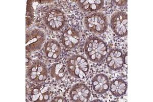 Immunohistochemical staining of human colon with DMRTA2 polyclonal antibody  shows moderate cytoplasmic positivity in glandular cells at 1:20-1:50 dilution.
