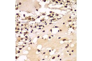 Immunohistochemistry of paraffin-embedded human kidney cancer using ZNF20 antibody at dilution of 1:100 (x400 lens). (ZNF20 anticorps)