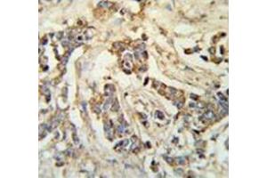 Immunohistochemistry analysis in breast carcinoma (Formalin-fixed, Paraffin-embedded) using MRAP Antibody (N-term), followed by peroxidase conjugated secondary antibody and DAB staining. (MRAP anticorps  (N-Term))
