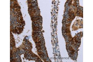 Immunohistochemistry of Human colon cancer using HMGCL Polyclonal Antibody at dilution of 1:30 (HMGCL anticorps)