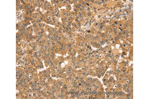 Immunohistochemistry of Human breast cancer using STX10 Polyclonal Antibody at dilution of 1:35 (Syntaxin 10 anticorps)