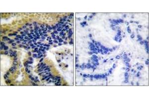 Immunohistochemistry analysis of paraffin-embedded human lung carcinoma tissue, using Caspase 9 (Cleaved-Asp330) Antibody.