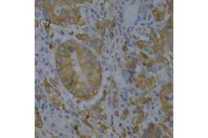 Immunohistochemistry of paraffin-embedded human gastric cancer using BIN1 Antibody (ABIN3022553, ABIN3022554, ABIN1678863 and ABIN6218901) at dilution of 1:200 (40x lens).