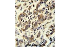 MBD3L3 Antibody (C-term) (ABIN656066 and ABIN2845416) immunohistochemistry analysis in formalin fixed and paraffin embedded human testis carcinoma followed by peroxidase conjugation of the secondary antibody and DAB staining. (MBD3L3 anticorps  (C-Term))