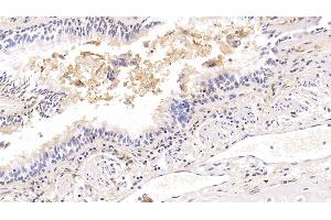 Detection of ICAM1 in Human Lung cancer Tissue using Monoclonal Antibody to Intercellular Adhesion Molecule 1 (ICAM1)