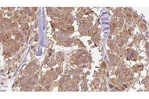 ABIN6274897 at 1/100 staining Human Melanoma tissue by IHC-P. (EPB41L2 anticorps  (Internal Region))