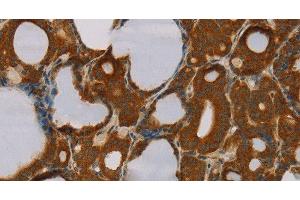 Immunohistochemistry of paraffin-embedded Human thyroid cancer tissue using PARP3 Polyclonal Antibody at dilution 1:40 (PARP3 anticorps)