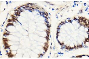 Immunohistochemistry of paraffin-embedded Human colon carcinoma using SNIP1 Polyclonal Antibody at dilution of 1:100 (40x lens).