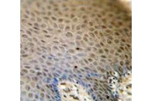 Immunohistochemistry analysis in human skin carcinoma, followed by peroxidase conjugation of the secondary antibody and DAB staining.