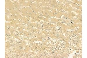 ABIN6261684 and ABIN6276377 at 1/100 staining human hepatocellular carcinoma by IHC-P.