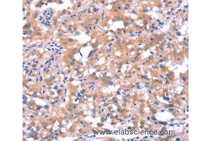 Immunohistochemistry of Human thyroid cancer using FAT1 Polyclonal Antibody at dilution of 1:40 (FAT1 anticorps)