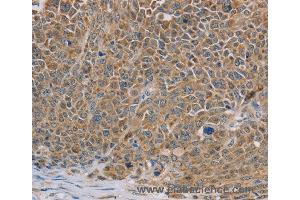 Immunohistochemistry of Human ovarian cancer using NDUFS7 Polyclonal Antibody at dilution of 1:40 (NDUFS7 anticorps)