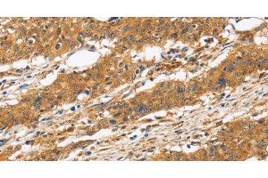 Immunohistochemistry of paraffin-embedded Human gasrtic cancer tissue using CD22 Polyclonal Antibody at dilution 1:50 (CD22 anticorps)