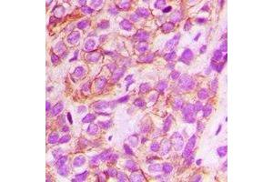 Immunohistochemical analysis of CD151 staining in human breast cancer formalin fixed paraffin embedded tissue section.