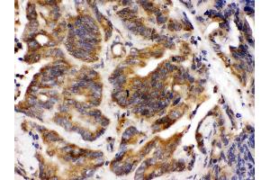 Talin 2 was detected in paraffin-embedded sections of human intestinal cancer tissues using rabbit anti- Talin 2 Antigen Affinity purified polyclonal antibody (Catalog # ) at 1 µg/mL.