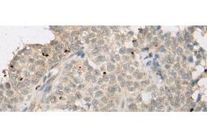 Immunohistochemistry of paraffin-embedded Human ovarian cancer tissue using ZNF449 Polyclonal Antibody at dilution of 1:50(x200) (ZNF449 anticorps)