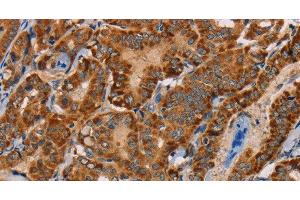 Immunohistochemistry of paraffin-embedded Human thyroid cancer tissue using MBNL3 Polyclonal Antibody at dilution 1:30 (MBNL3 anticorps)
