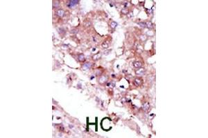 Formalin-fixed and paraffin-embedded human cancer tissue reacted with the primary antibody, which was peroxidase-conjugated to the secondary antibody, followed by DAB staining.