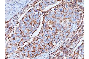 Formalin-fixed, paraffin-embedded human Breast tissue stained with CD44 Mouse Monoclonal Antibody (DF1485). (CD44 anticorps)