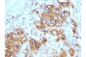 Formalin-fixed, paraffin-embedded human gastric carcinoma stained with CA19-9 antibody (121SLE). (CA 19-9 anticorps)