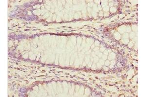 Immunohistochemistry of paraffin-embedded human colon cancer using ABIN7152363 at dilution of 1:100 (EYA3 anticorps  (AA 1-300))