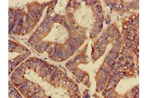 Immunohistochemistry of paraffin-embedded human endometrial cancer using ABIN7154155 at dilution of 1:100 (GPAM anticorps  (AA 281-459))