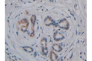 Detection of GPLD1 in Human Pancreatic cancer Tissue using Polyclonal Antibody to Glycosylphosphatidylinositol Specific Phospholipase D1 (GPLD1) (GPLD1 anticorps  (AA 496-840))