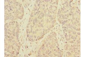 Immunohistochemistry of paraffin-embedded human ovarian cancer using ABIN7173139 at dilution of 1:100 (TMEM209 anticorps  (AA 251-519))
