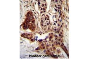 CCDC122 antibody (C-term) immunohistochemistry analysis in formalin fixed and paraffin embedded human bladder carcinoma followed by peroxidase conjugation of the secondary antibody and DAB staining.