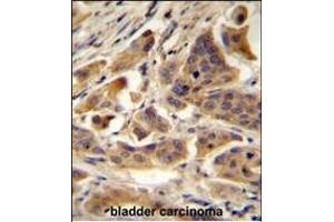 RBCK1 (UBCE7IP3) Antibody (N-term) A immunohistochemistry analysis in formalin fixed and paraffin embedded human bladder carcinoma followed by peroxidase conjugation of the secondary antibody and DAB staining. (RBCK1 anticorps  (N-Term))