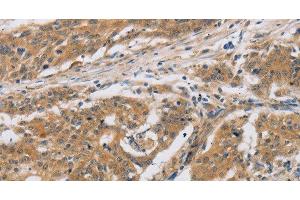 Immunohistochemistry of paraffin-embedded Human ovarian cancer tissue using CST6 Polyclonal Antibody at dilution 1:30