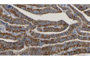 ABIN6267175 at 1/100 staining Human thyroid cancer tissue by IHC-P.