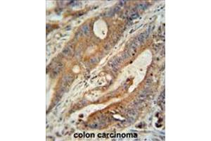 ZBBX antibody (N-term) immunohistochemistry analysis in formalin fixed and paraffin embedded human colon carcinoma followed by peroxidase conjugation of the secondary antibody and DAB staining. (ZBBX anticorps  (N-Term))