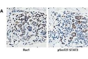 STAT3 signaling is downstream of Rac activity during invasion of human breast cancer(A) Immunohistochemistry shows that Rac1 protein expression (left panel) and STAT3 phosphorylation on Ser727 (right panel) frequently coincide in human breast cancer.