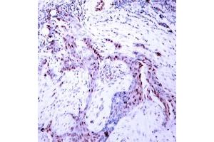 Immunohistochemical analysis of paraffin- embedded human breast carcinoma tissue, using Progesterone Receptor (phospho-Ser190) antibody (E011074). (Progesterone Receptor anticorps  (pSer190))