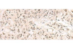 Immunohistochemistry of paraffin-embedded Human prost ate cancer tissue using WEE1 Polyclonal Antibody at dilution of 1:35(x200) (WEE1 anticorps)