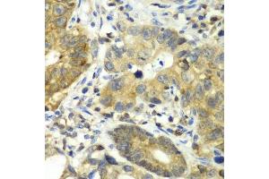 Immunohistochemistry of paraffin-embedded human gastric cancer using DPP3 antibody. (DPP3 anticorps  (AA 1-280))