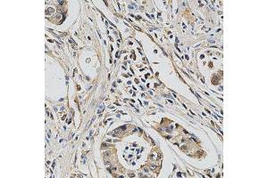 Immunohistochemistry of paraffin-embedded human stomach cancer using EIF4E antibody at dilution of 1:200 (x400 lens)