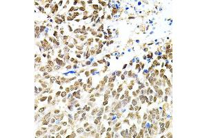 Immunohistochemistry of paraffin-embedded human lung cancer using PNKP antibody (ABIN2564598) at dilution of 1:100 (40x lens). (PNKP anticorps)