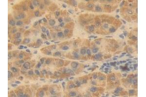 Detection of OTC in Human Liver cancer Tissue using Polyclonal Antibody to Ornithine Transcarbamylase (OTC)