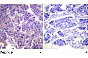 Immunohistochemical analysis of paraffin-embedded human breast carcinoma tissue using CALD1 polyclonal antibody . (Caldesmon anticorps)