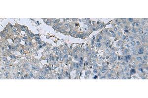 Immunohistochemistry of paraffin-embedded Human liver cancer tissue using GLS Polyclonal Antibody at dilution of 1:70(x200) (Glutaminase anticorps)
