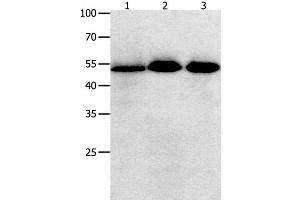 Western Blot analysis of Human lymphoma , ovarian and colon cancer tissue using KLF5 Polyclonal Antibody at dilution of 1:350 (KLF5 anticorps)