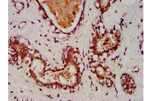 IHC image of ABIN7151354 diluted at 1:1000 and staining in paraffin-embedded human breast cancer performed on a Leica BondTM system.